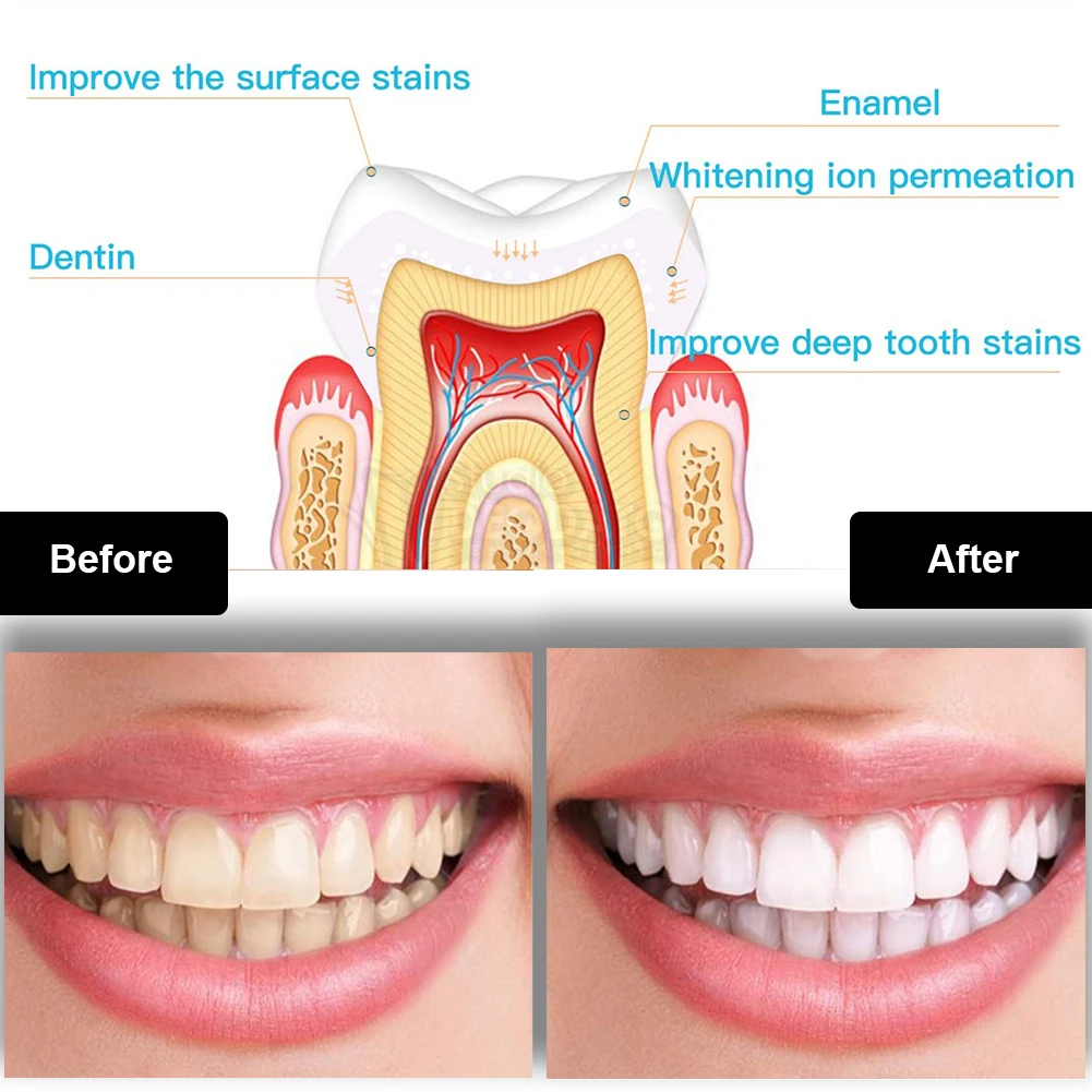 Zestaw do wybielania zębów den – Teeth Whitening Results recenzja i cena